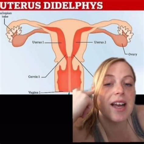 Uterus Didelphys Woman Learns She Has Two Vaginas While Giving Birth