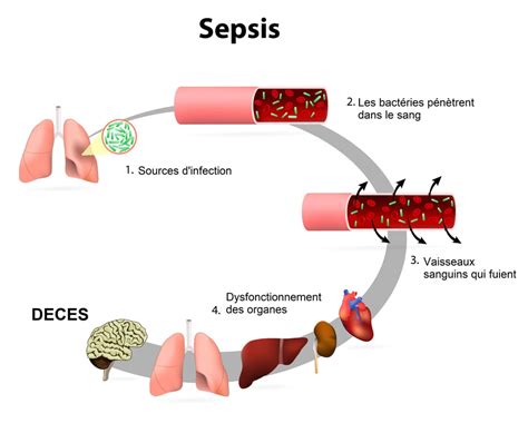 Signs Treatment A Risk Of Septic Shock