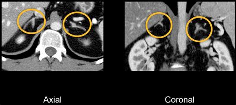 Abdominal Ct Spleen And Adrenal Glands Litfl Radiology