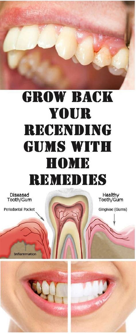 There Are A Lot Of Reasons Why Gums Recede And It Can Become Quite A