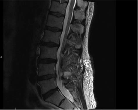 Mri Lumbar Spine Labeled