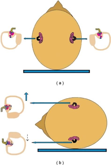 Mechanism Of Cupulolithiasis Of Bilateral Apogeotropic Open I