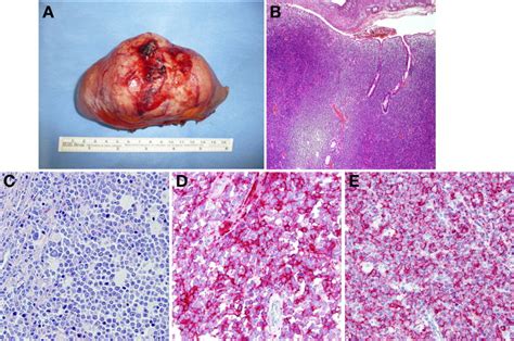Diffuse Large B Cell Lymphoma Of The Small Bowel As An Unusual Cause