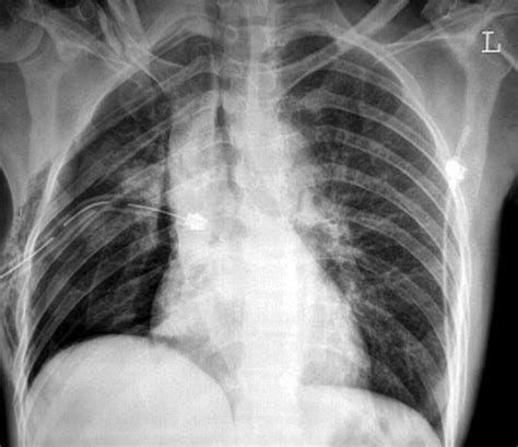 However, if the leak or pneumothorax is large, then subcutaneous emphysema or an expanding symptomatic pneumothorax is more likely. Tension pneumothorax and the "forbidden CXR" | Emergency Medicine Journal