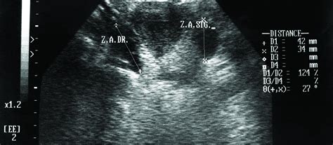 This ultrasound makes it possible for your doctor to obtain real time. Missed opportunities over 18 months mean ovarian cancer ...