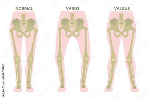 Valgus And Varus Leg Deformities Diagram Showing The Deformed Bones Of The Lower Extremities