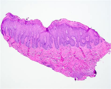 Pathology Outlines Proliferative Verrucous Leukoplakia Pvl