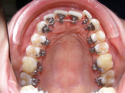Bloggingforfun6395 Dental Braces Inside Teeth