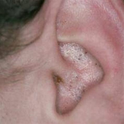 What Causes Blackheads In The Ears Healthy Living
