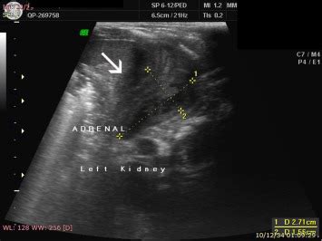 Ultrasound Showing That The Left Adrenal Gland Was Enlarged And Hot Sex Picture