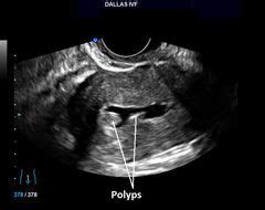 A small hollow tube or catheter is inserted into a vein and left in place. Saline Sonogram | Saline sonogram, Sonogram, Saline ultrasound