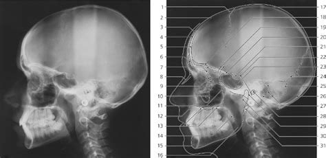 Nasal Bone X Ray Ap View Nasal Bones Superoinferior Axial