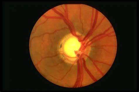 Optic Disc Evaluation American Academy Of Ophthalmology