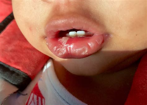 Canker sores occur singly or in clusters on the inside surfaces of your cheeks or lips, on or under your tongue, at mayo clinic does not endorse companies or products. Causes and Treatment of a Baby Canker Sore | mccac.org
