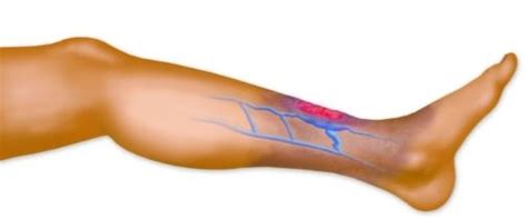 Discover 10 common blood clot symptoms at 10faq health and stay better informed to make healthy living decisions. Blood Clot in Leg - Symptoms, Signs, Causes, Diagnosis ...