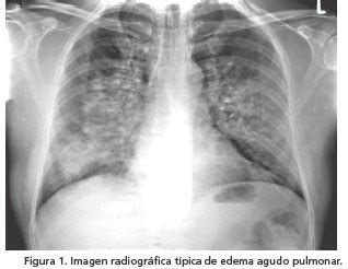 Edema Agudo de Pulmão EAP Flashcards Quizlet