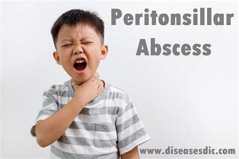 Peritonsillar Abscess Pathophysiology Causes And Prevention