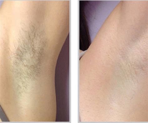 The energy, however, is lower so it can safely be used at home. Laser Hair Removal Gallery | Skintegrity Medspa in ...