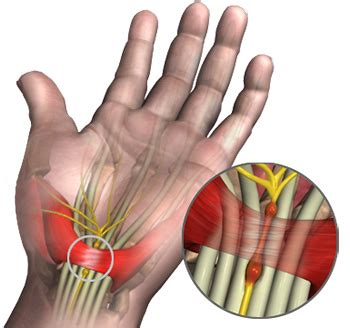 Carpal tunnel syndrome, also called median nerve compression, is a condition that causes numbness, tingling, or weakness in your hand. Carpal Tunnel Syndrome Stoke-on-Trent | Carpal Tunnel ...