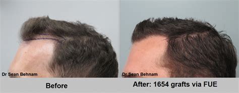 Fue Hair Transplant Los Angeles Dr Sean Behnam