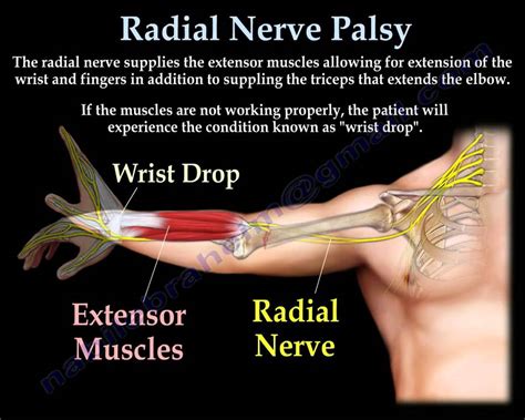 Radial Nerve Palsy Injury Wrist Drop Everything You Need To Know Dr