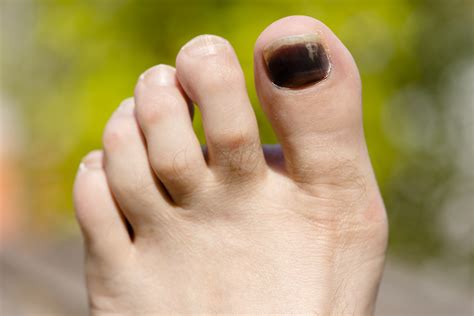 Have A Black Toenail Here Are 3 Reasons Why Triad Foot And Ankle Center