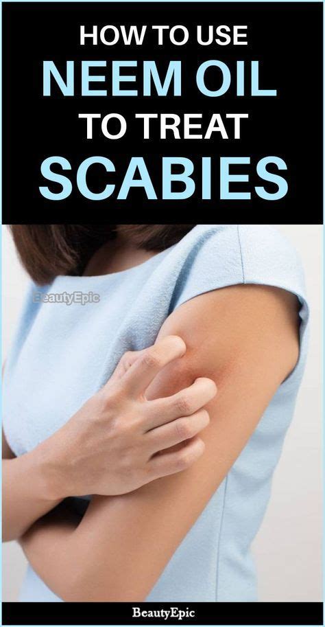 7 Scabies Treatment Ideas In 2021 Scabies Treatment Scabies Treatment