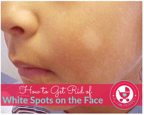 How To Get Rid Of White Spots On Face