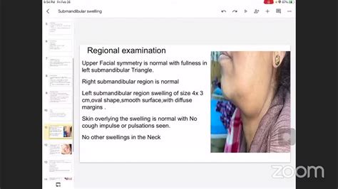 Case Presentation Submandibular Swelling Youtube