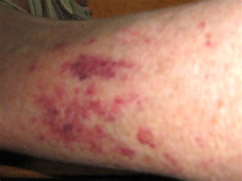 I Have Large Dark Red Blotches On Both Legs I Can Send A Picture
