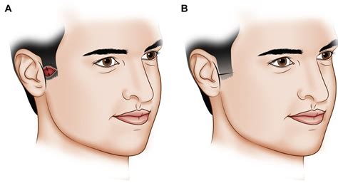 Reconstruction Of Cheek Defects Secondary To Mohs Microsurgery Or Wide
