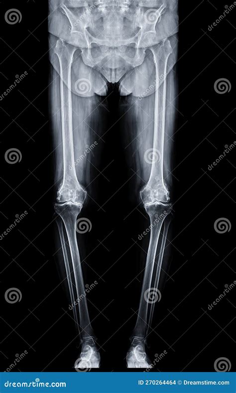 Scanogram Is A Full Length Standing Ap Radiograph Of Both Lower Extremities Including The Hip