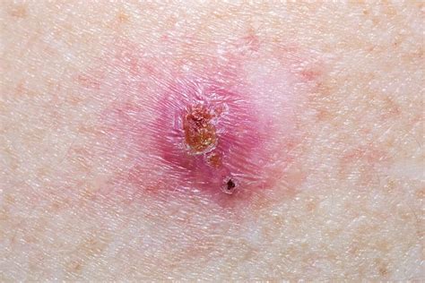 What Does Early Stage Basal Cell Carcinoma Look Like Common Types Of