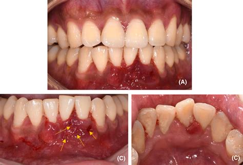 A Case Of Acute Necrotizing Periodontitis With Not Known Origin Ren