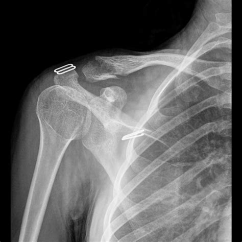 Distal Clavicle Fracture Image