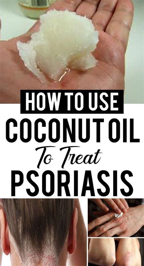 Natural Herbal Remedies Coconut Oil For Psoriasis Psoriasis Skin