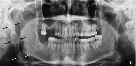 Panoramic Radiograph Showing A Large Radiopaque Area Arrows Running