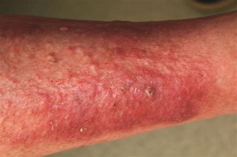 Dupilumab Gets Early Access Nod From Uk Regulator For Atopic Dermatitis