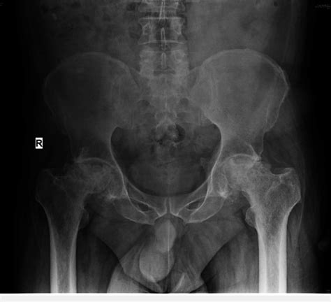 X Ray Pelvis Anteroposterior View Showing Avascular Necrosis Of The