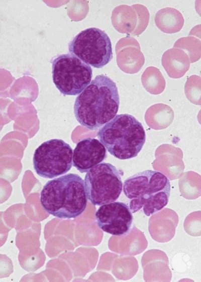 Flower Cells Of Leukemia
