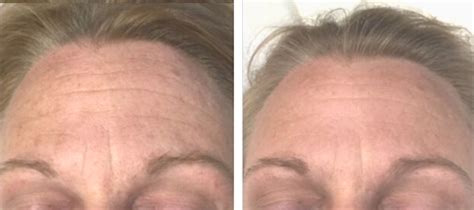 New SkinStylus® Microneedling Before & After Photos - AMAE Med Spa