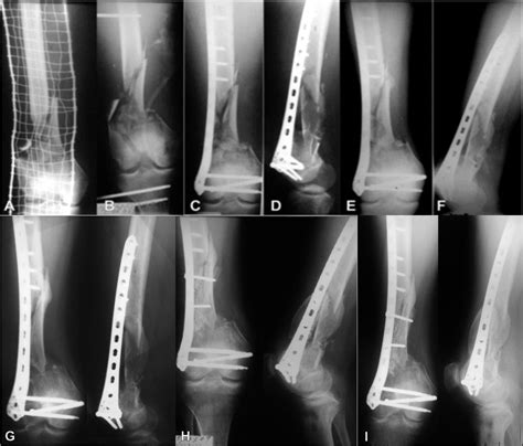 Minimally Invasive Plate Osteosynthesis Mipo In Long Bone Fractures