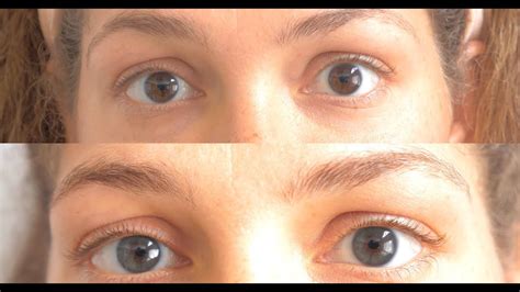 Model Lasered Her Eye Color From Brown To Blue Permanently Irex Laser