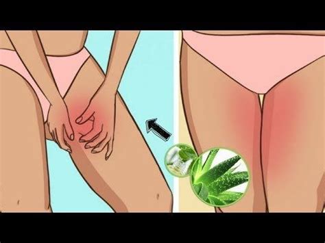 Itching of the groin is as common as itching anywhere on the body. Cyst on Inner Thigh near Groin Female - Home Remedies for ...