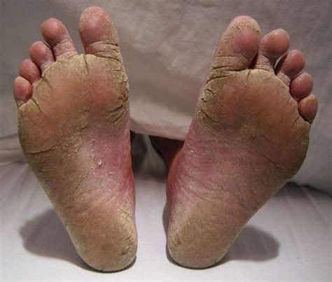 10 Natural Remedies To Get Rid Of Fungal Infection Between Toes