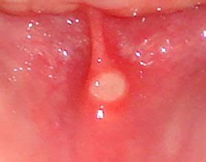 What is a canker sore? Canker Sore vs Cold Sore | Study.com