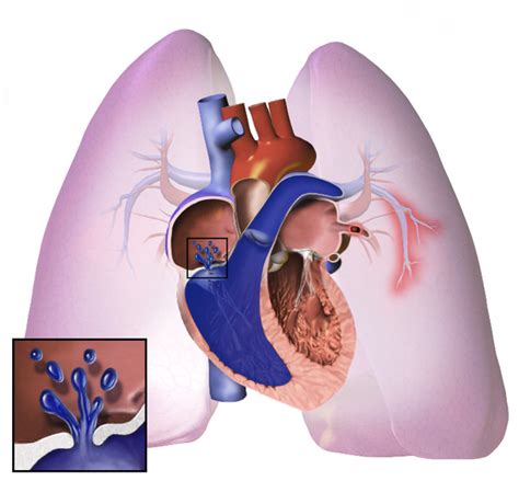 Pulmonary Hypertension Wikipedia