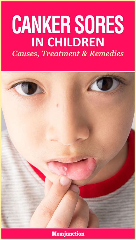 What Causes Canker Sores In Kids And How To Treat Them Cankers