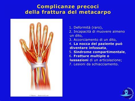 Frattura del Metacarpo: Cosa Fare e gli Esercizi di ...