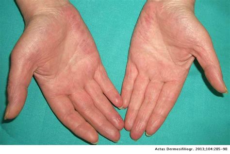 Palmar erythema is a reddening of the palms, especially around the base of the little finger and thumb. Cutaneous Alerts in Systemic Malignancy: Part I | Actas ...